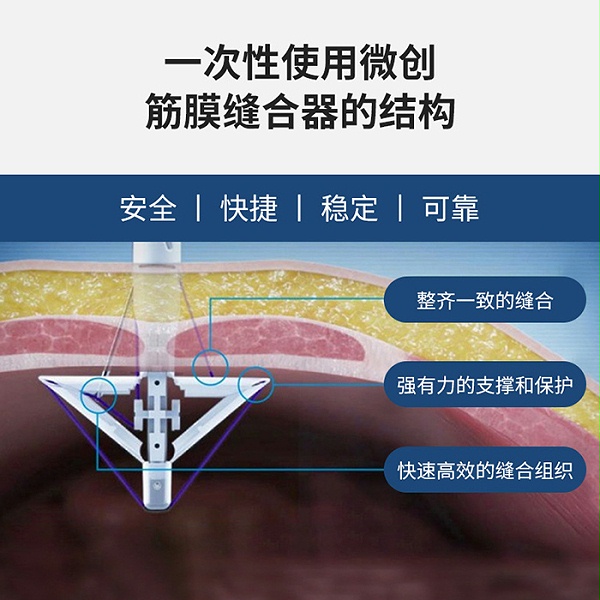 舒扩 一次性使用微创筋膜缝合器